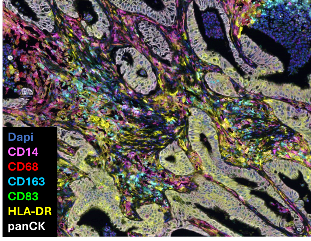 Tumor micro environment, showing myeloid cells such as macrophages, Monocytes and dendritic cells. Multiplex immunohistochemistry using 7 colours.
